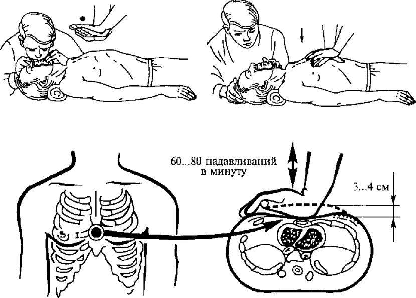 Непрямой массаж сердца Непрямой массаж сердца