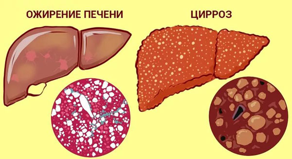 Ожирение печени и цирроз печени