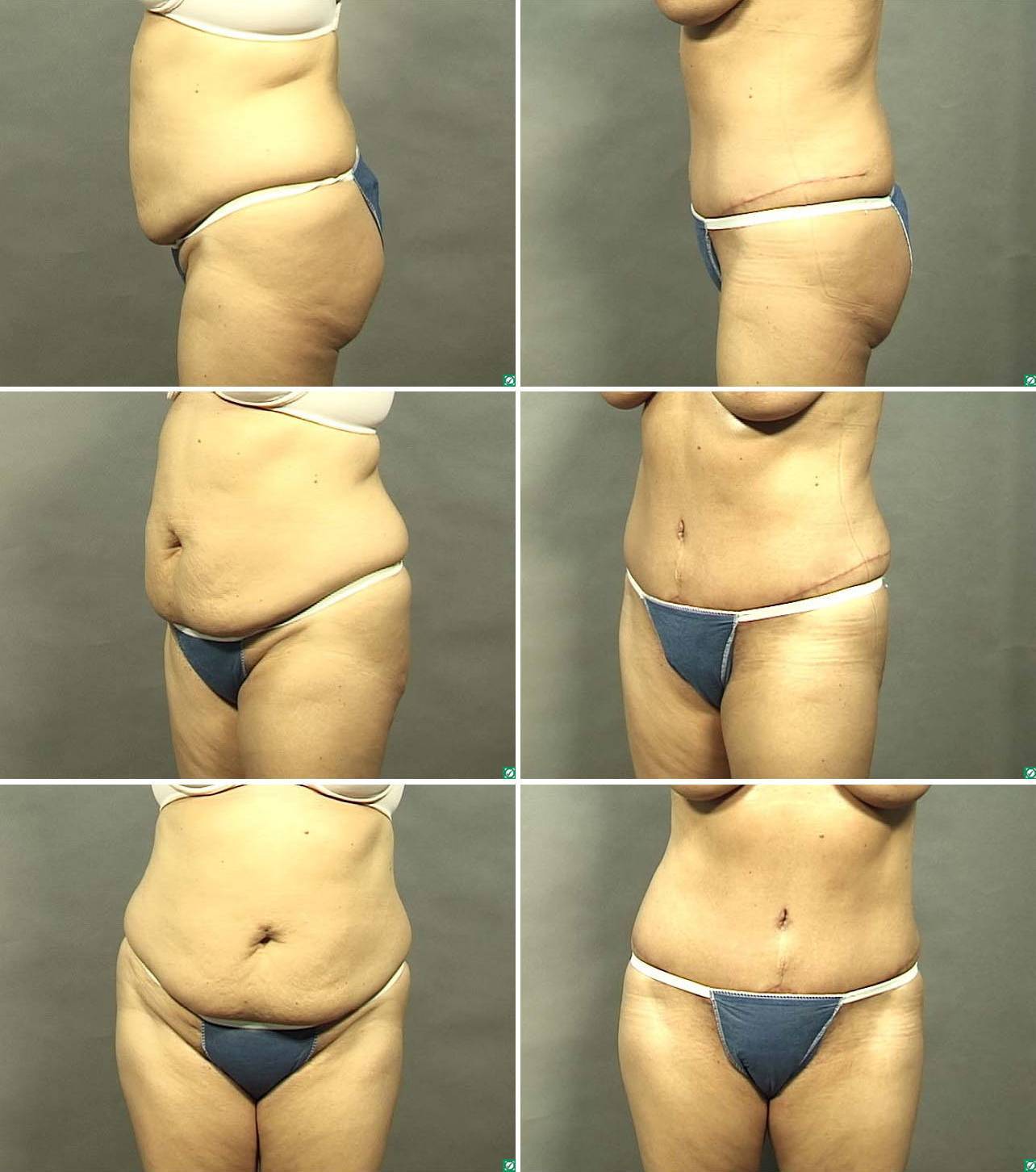 Удаление матки: последствия для организма после 40 лет