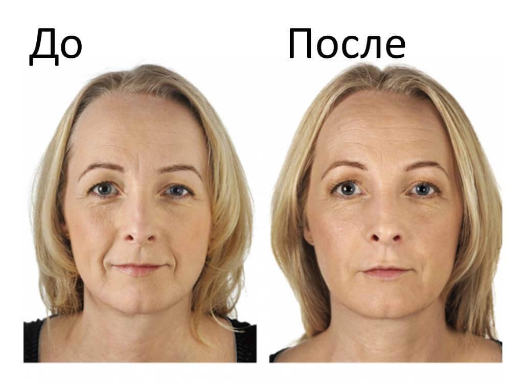 Фотоомоложение кожи лица: плюсы и минусы, эффект и уход после лазерной процедуры