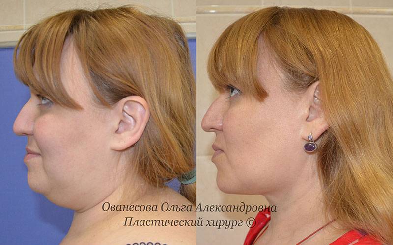 Липосакция вдовьего горба