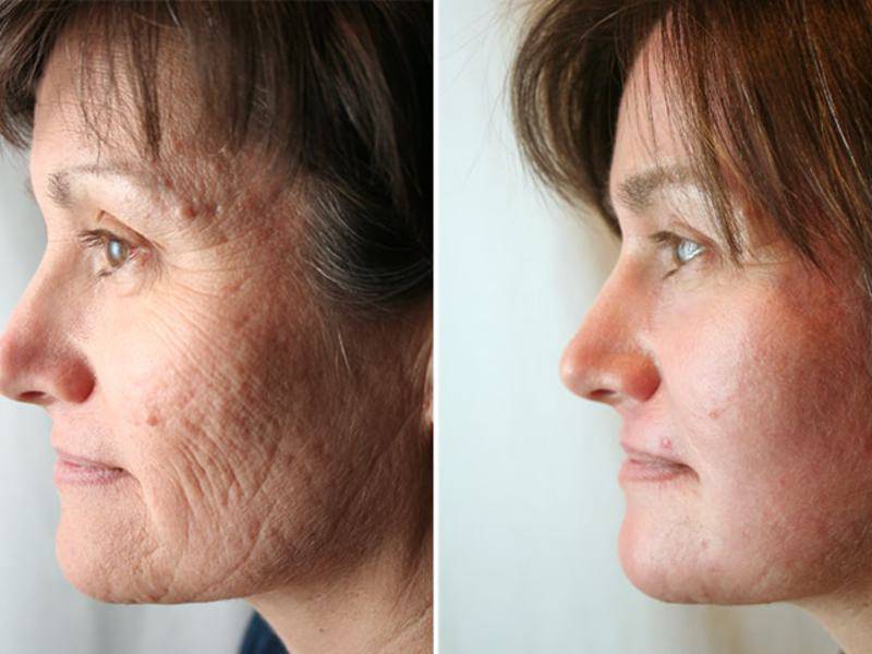 Что такое лазерная шлифовка кожи: подробное описание процедуры