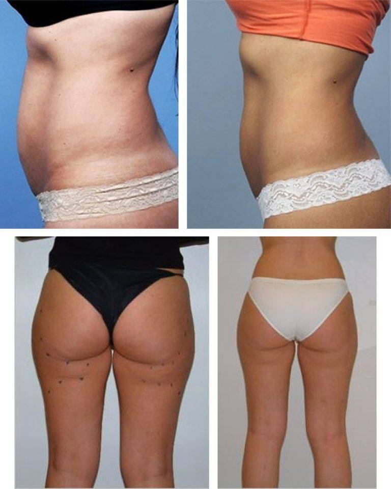Безоперационная липосакция: виды, цены, фото, отзывы