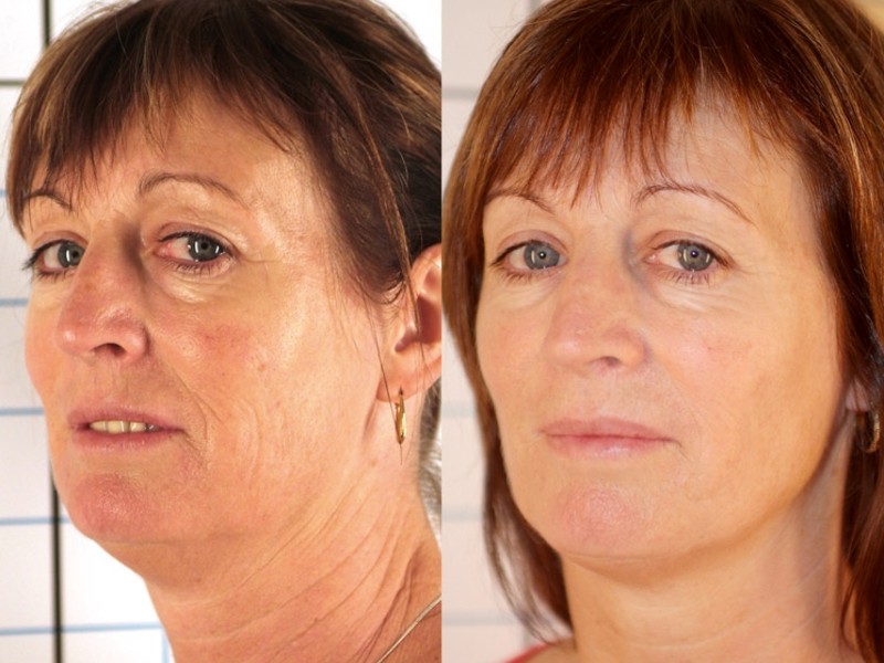 Фотоомоложение лица