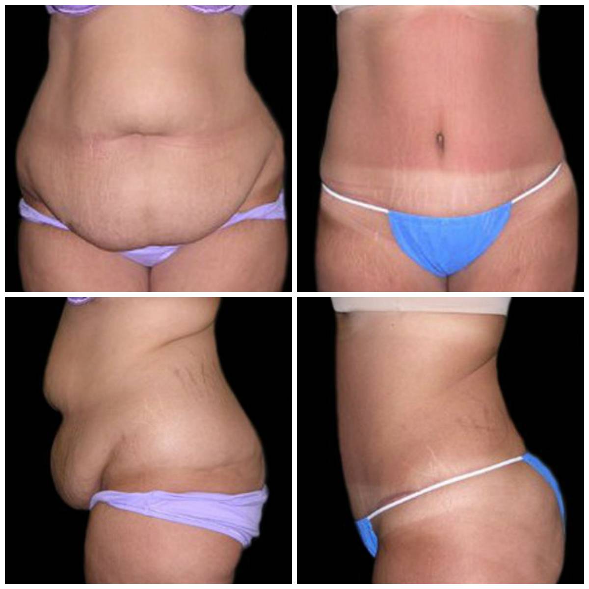 Лазерная липосакция живота, ягодичной области и лица