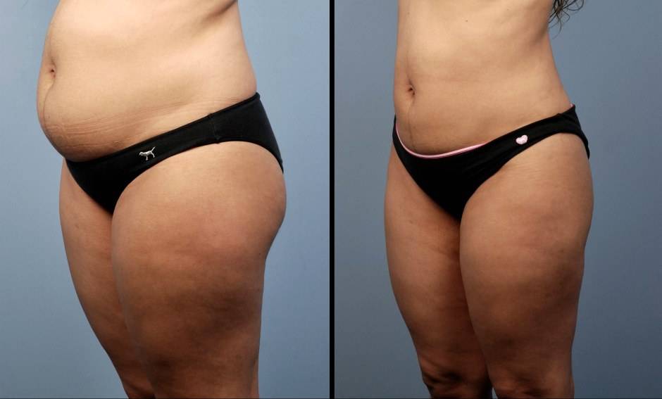 Последствия липосакции: вред откачки жира и чего бояться после операции?