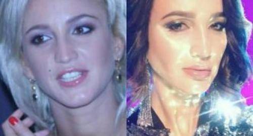 Внешность ольги бузовой до и после пластики