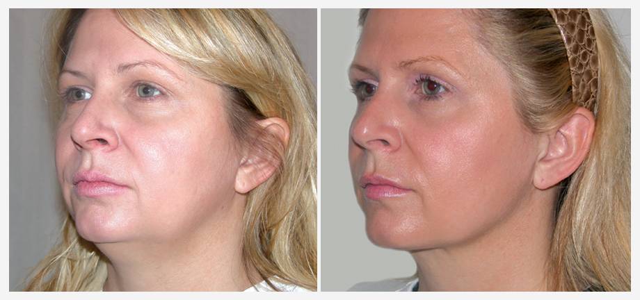 Лазерный липолиз: что это такое, показания, противопоказания