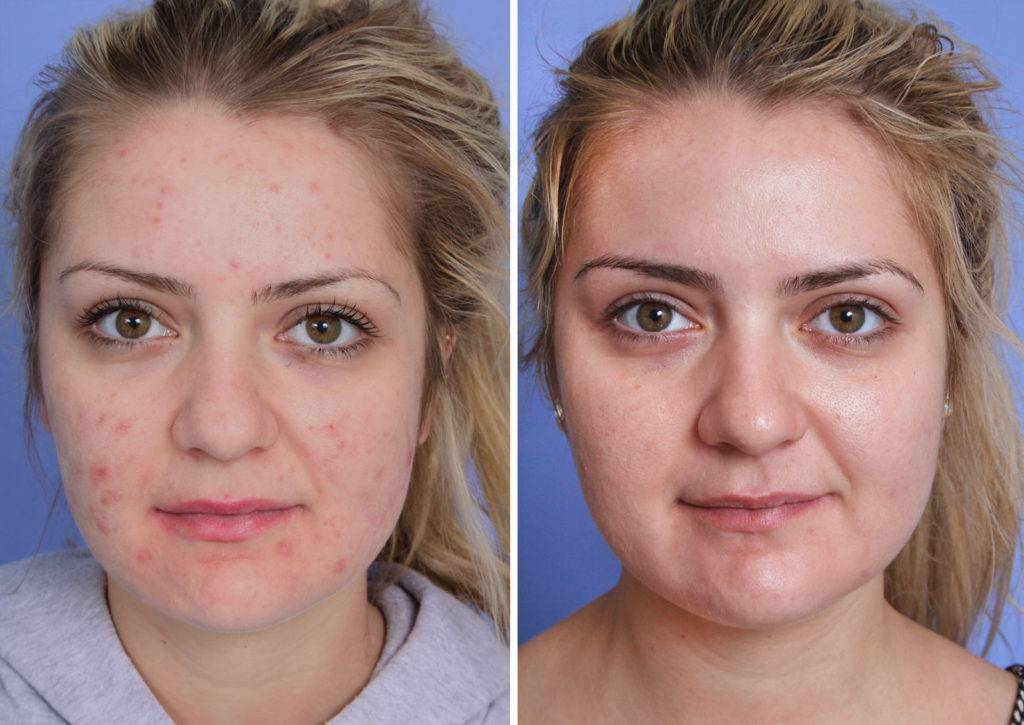 Лазерное омоложение лица: виды процедур