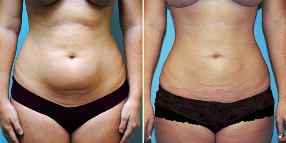 Липосакция живота – отзывы, лазерная и ультразвуковая методики, фото