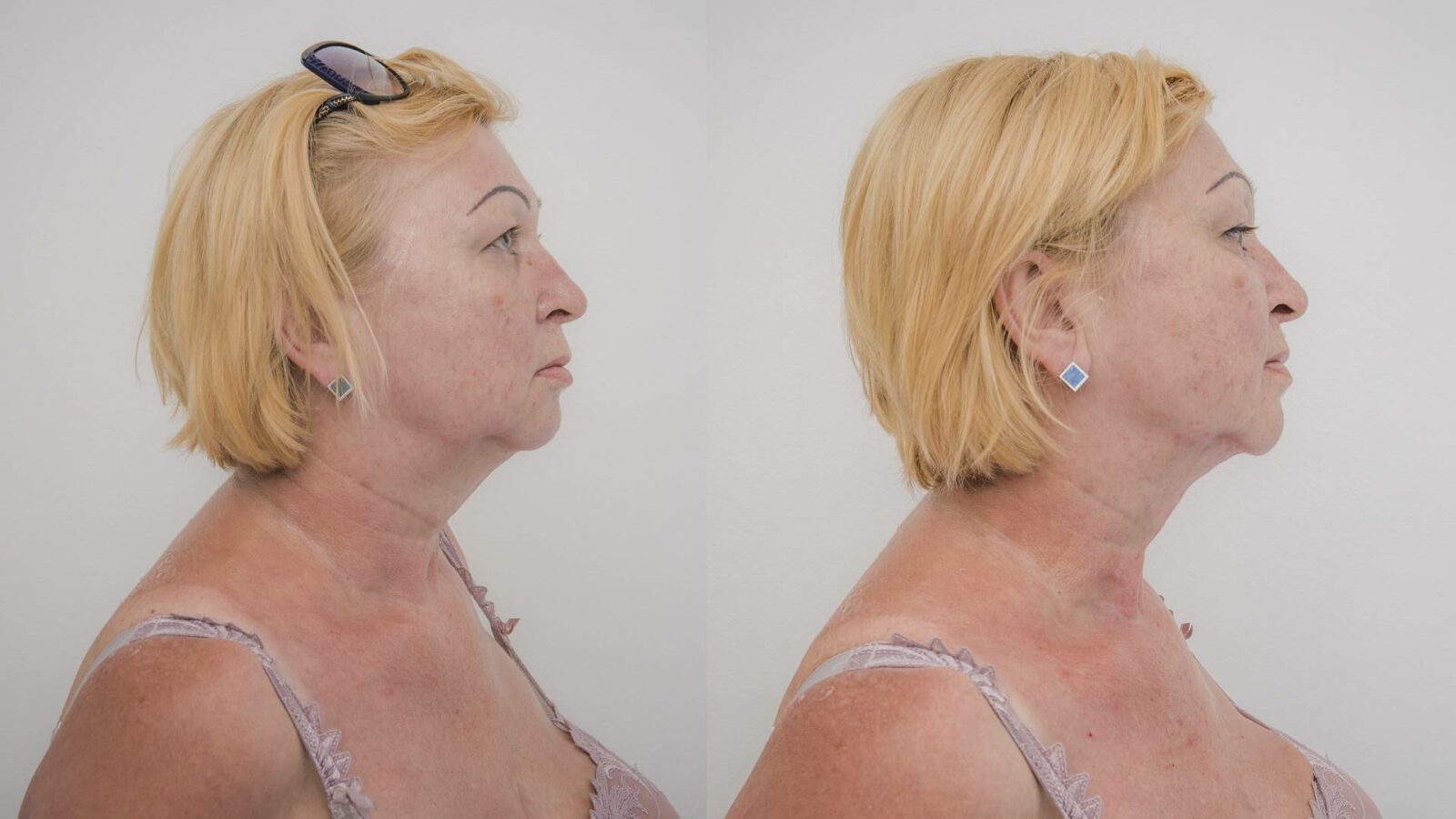 Удаление вдовьего горба - цена липосакции холки на шее