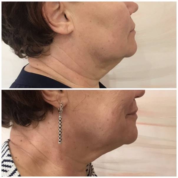 Липосакция вдовьего горба | клиника abc