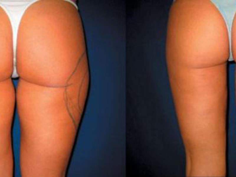 Лазерная липосакция живота: что это такое, фото до и после