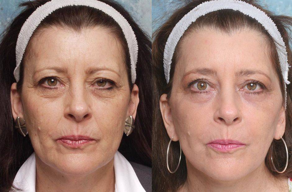 Фотоомоложение лица: что это такое, плюсы и минусы, кожа до и после процедуры