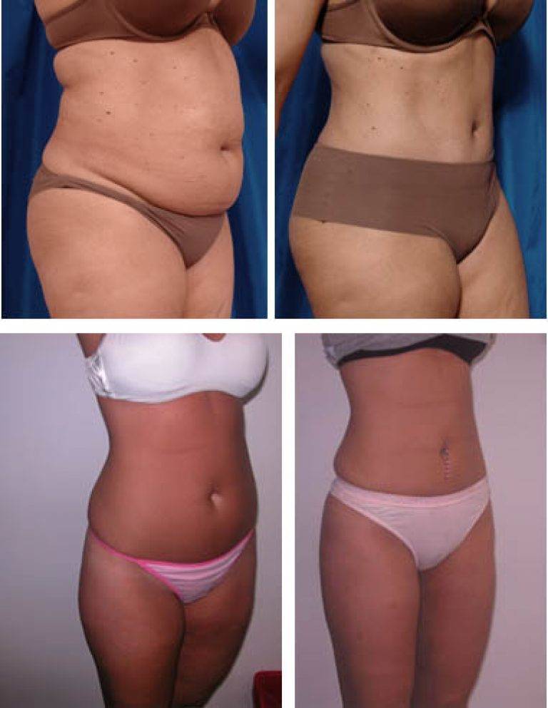 Эффективность процедуры похудения живота с помощью липолитиков — отзывы профессионалов