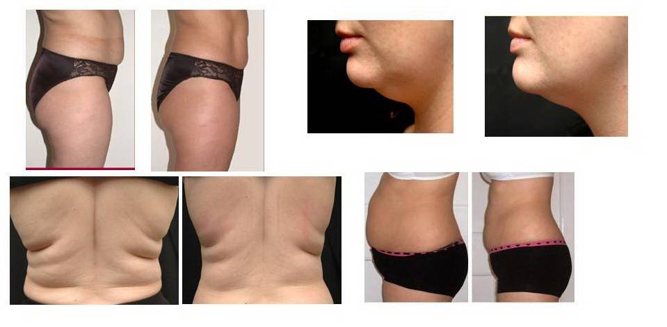 Акваликс (aqualyx)