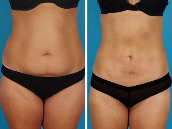 Липолитики для похудения живота и боков: фото до и после