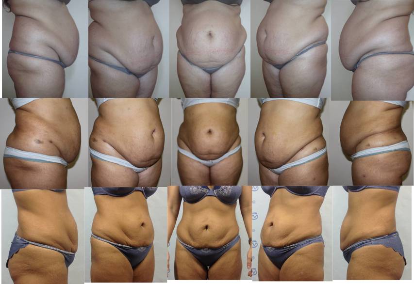 Особенности удаления матки после 50 лет