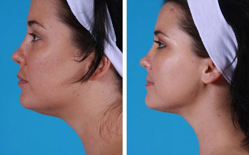 Что такое лазерная подтяжка лица, как ее делают, в чем преимущества?