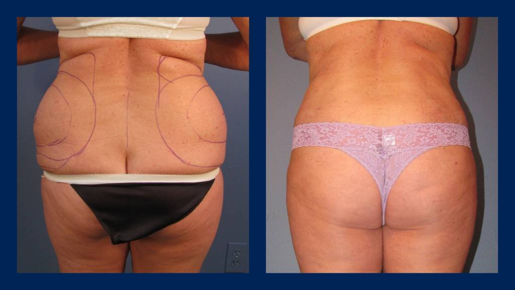 Липосакция - виды, как делается, противопоказания + стоимость и фото до и после