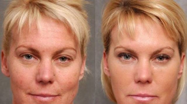 Лазерное омоложение лица — противопоказания