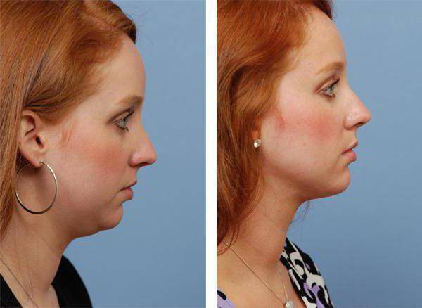 Липолитики для лица: отзывы, фото до и после применения