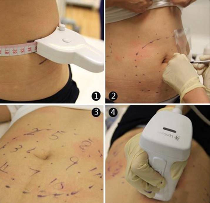 Липосакция ультразвуковая (кавитация) – уберите жир навсегда (2021)