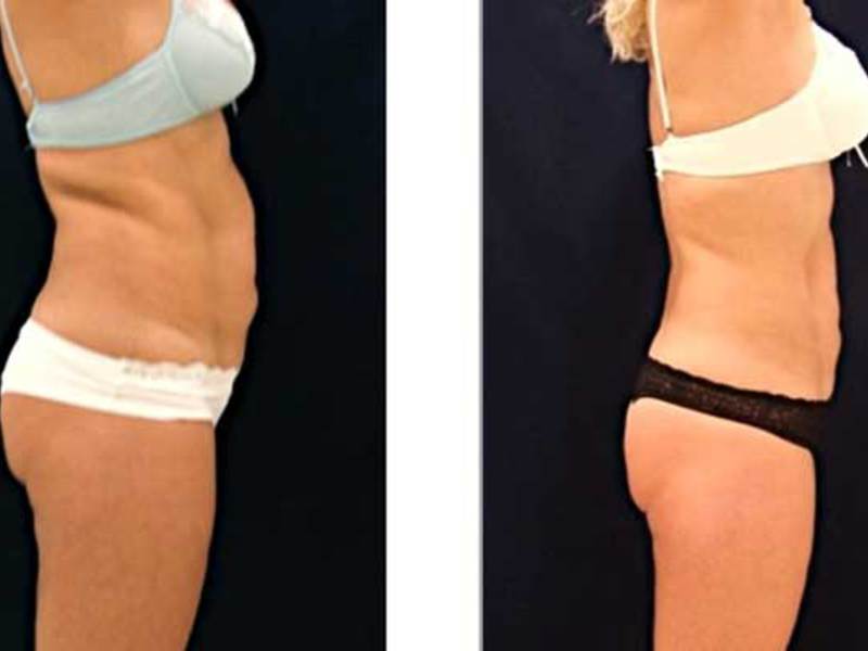 Безоперационная липосакция: что такое, фото живота, шеи, щек