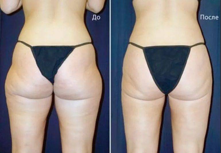 Липосакция живота: отзывы