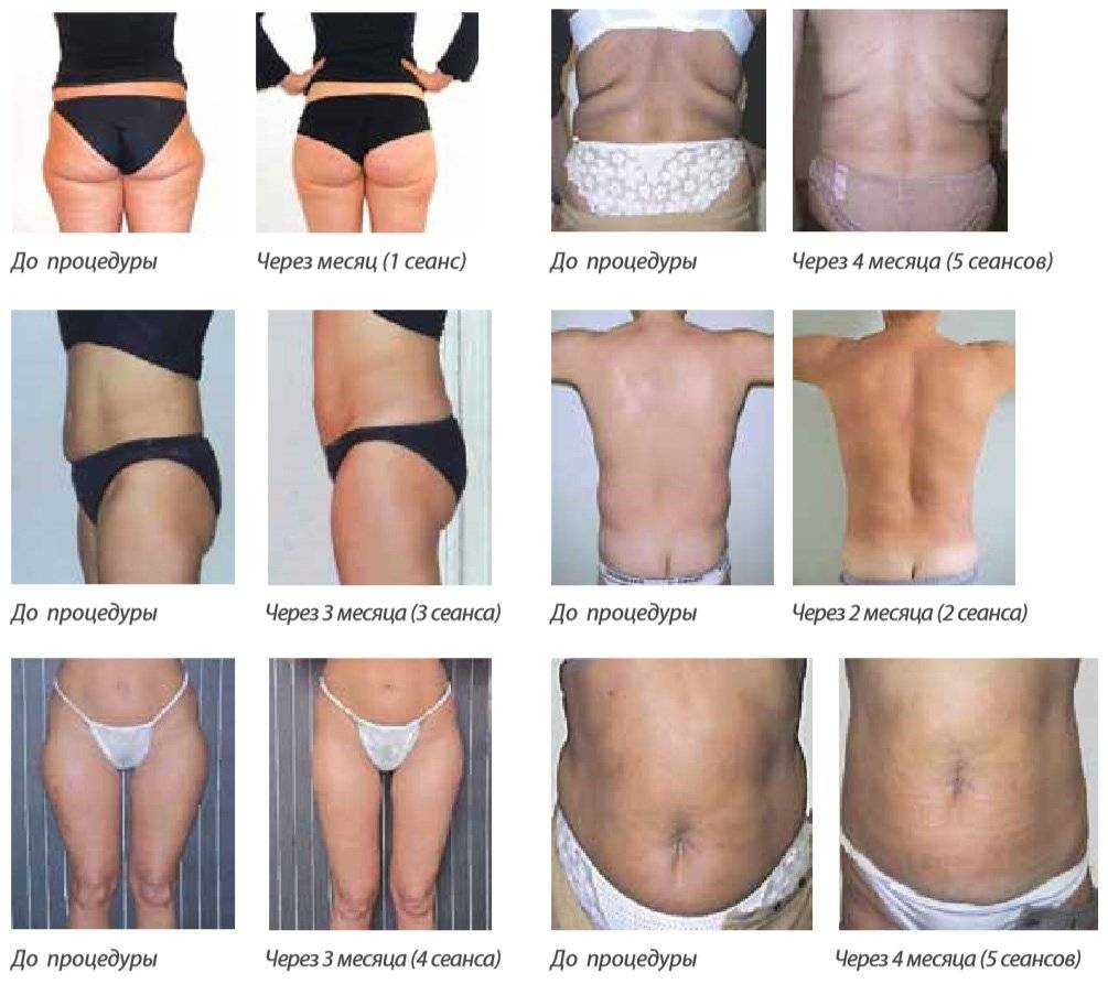 Уколы для похудения: отзывы и стоимость - allslim.ru