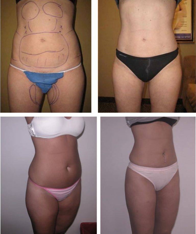 Как бороться с жиром с помощью лазерной липосакции живота? что это такое и каков результат на фото?