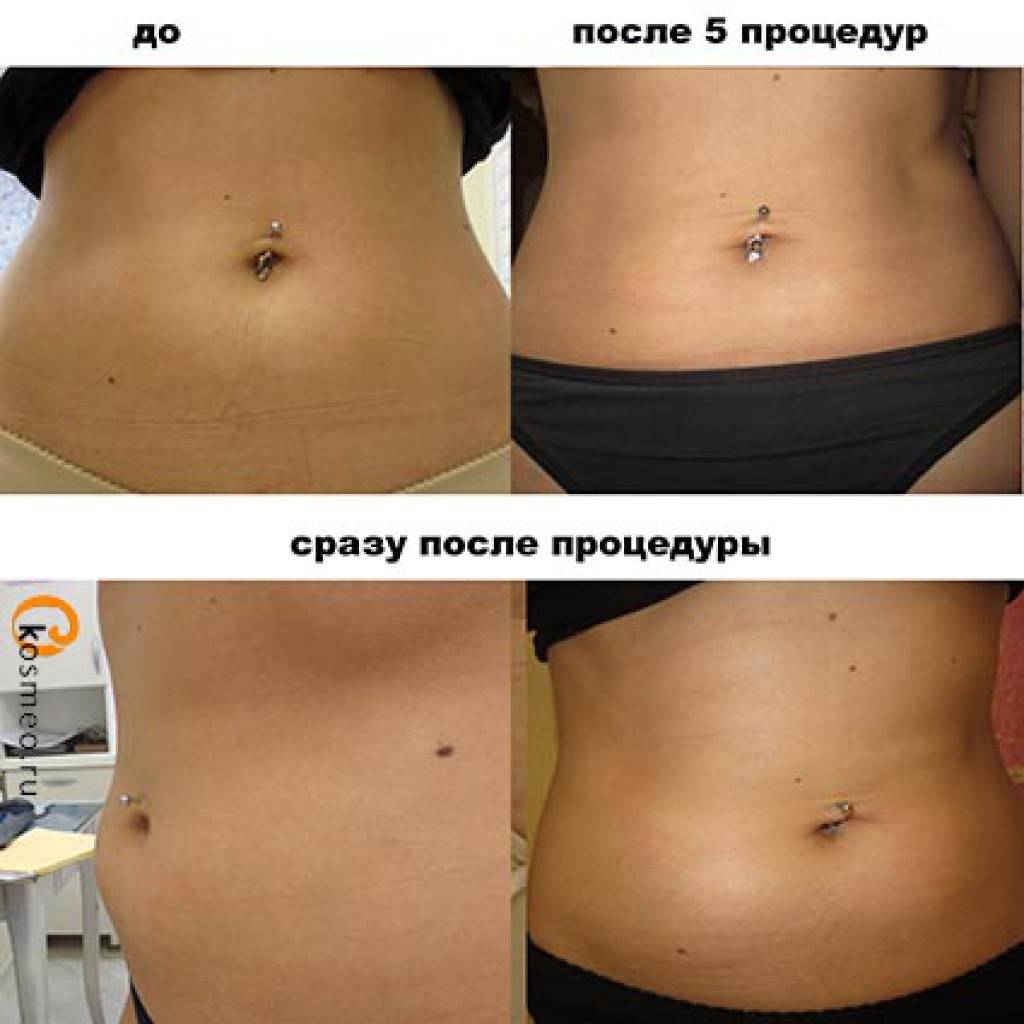 Липолитики для похудения: применение, препараты, фото, отзывы