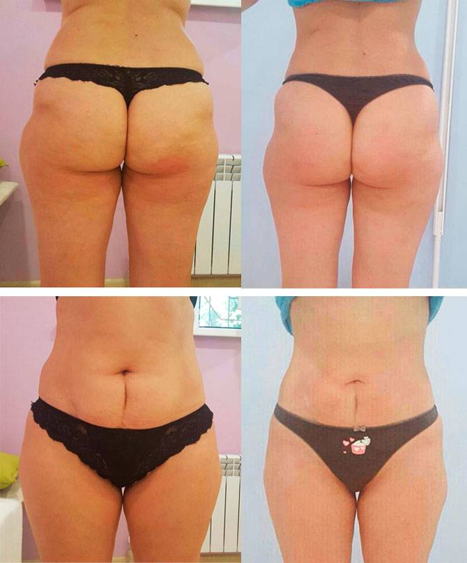 Липолиз, что это такое, виды, как проводится лазерный, инъекционный, rf, вакуумный, фото до и после, отзывы