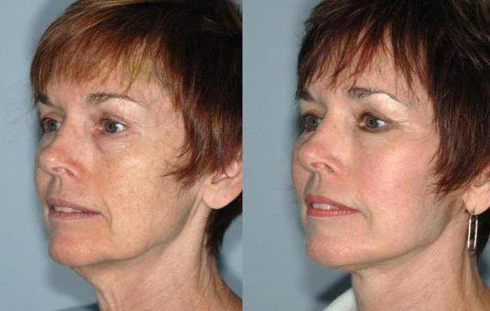 Лазерная липосакция: описание метода, показания и противопоказания