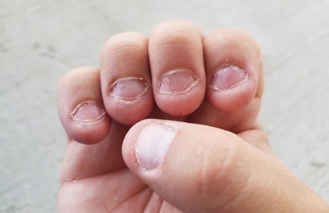 Страшные ногти впоследствии грызения 