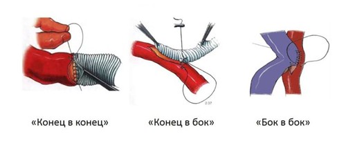 Типы сосудистых анастомозов