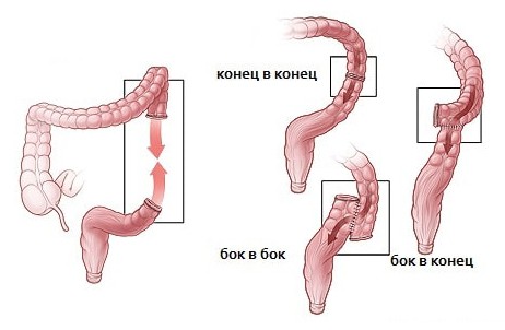 Виды анастомозов кишечника
