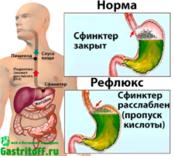 Рефлюкс-эзофагит в желудке человека