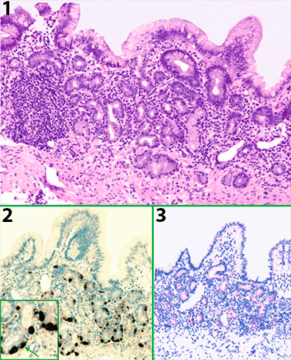 Аутоиммунный гастрит на слизистой желудка человека