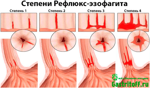 4 степени развития рефлюкс-эзофагита