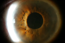 синдром пигментной дисперсии