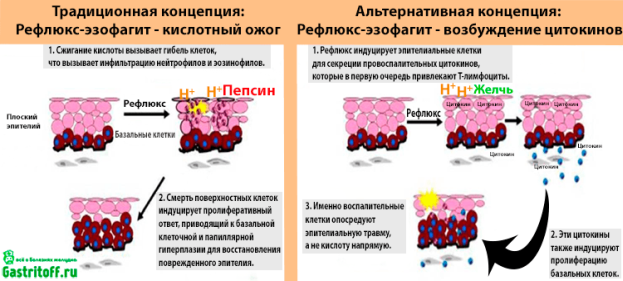 Что происходит при рефлюкс-эзофагите